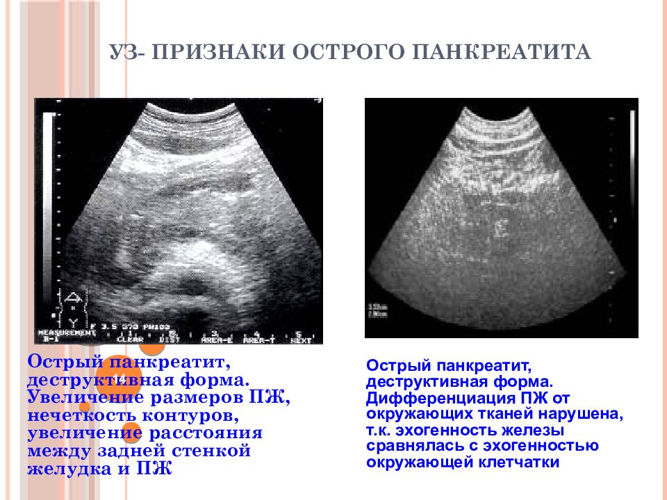 Панкреатит признаки. Острый панкреатит симптомы. Деструктивная форма панкреатита. Острый деструктивный панкреатит.