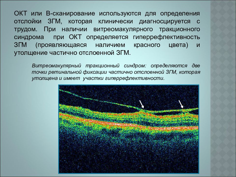 Окт. Окт макулярной зоны глаза. Оптическая когерентная томография норма. Оптическая когерентная томография макулы. Тракционный макулярный отек.