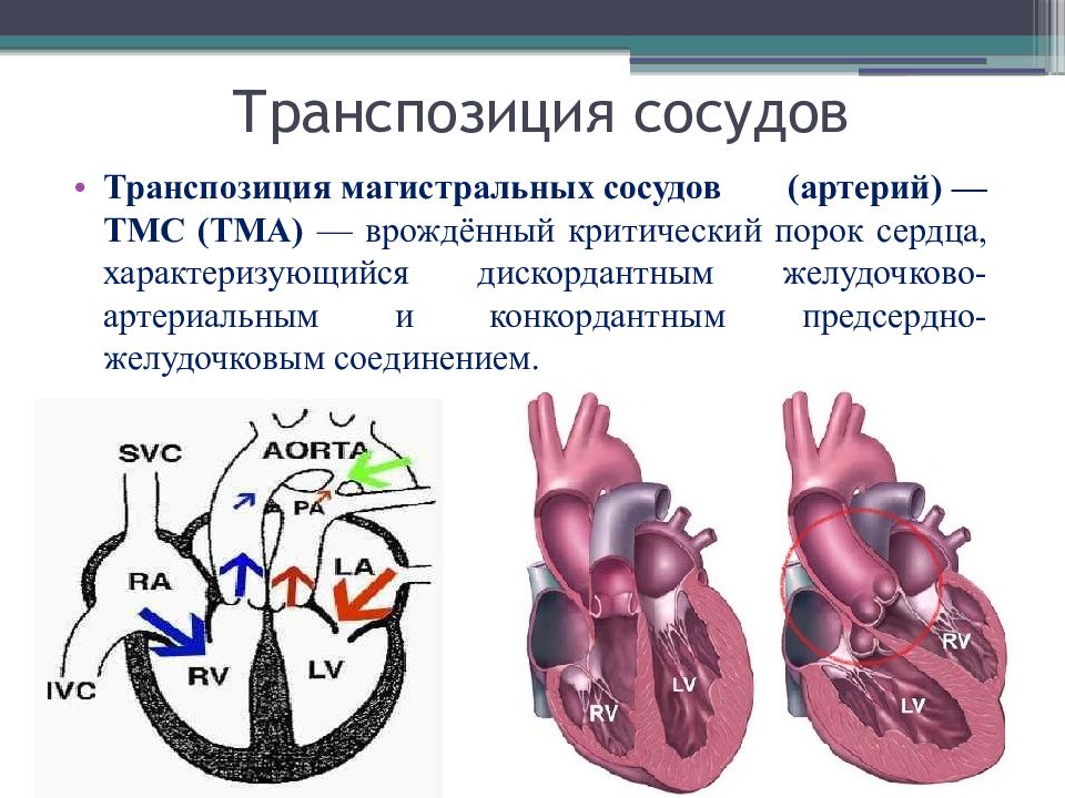 Транспозиция артерий