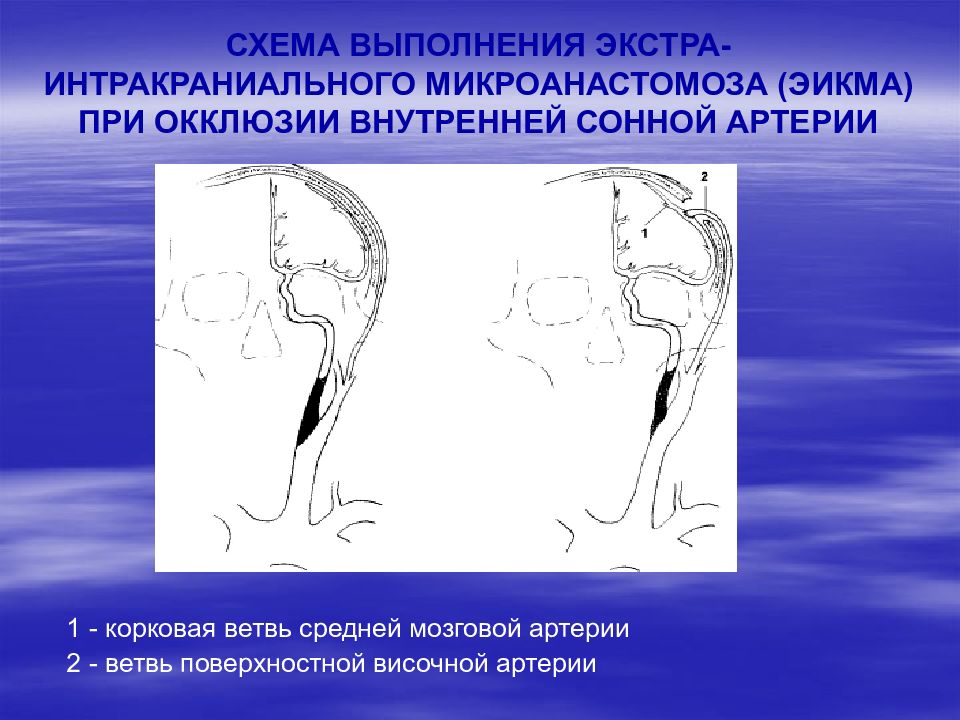 Окклюзия сонной артерии. Экстраинтракраниальный микроанастомоз. Экстра- интракраниального микроанастомоза.