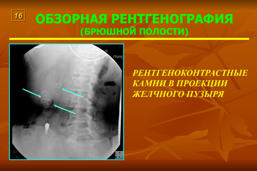 Проекция желчного. Рентген брюшной полости ЖКБ. Конкременты желчного пузыря рентген. Рентгенография желчекаменная болезнь. Обзорная рентгенография брюшной полости.