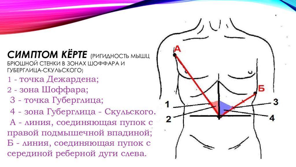 Точка п середине. Острый панкреатит симптом Мейо–Робсона. Симптомы Керте, Мейо—Робсона, Воскресенского. Симптомы панкреатита Мейо Робсона. Симптомы Керте острого панкреатита.