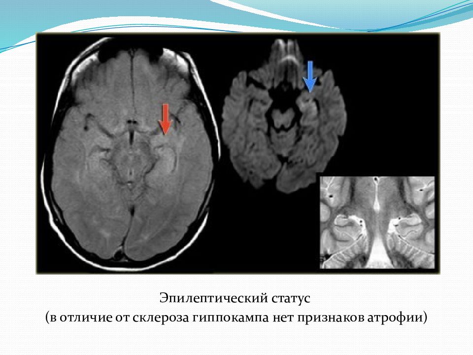 Темпоральный склероз. Гиппокамп анатомия мрт. Объемные образования гиппокампа. Атрофия гиппокампа на мрт. Гиппокамп головного мозга на мрт.