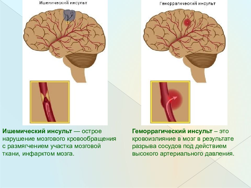 Что такое ишемический инсульт головного мозга. Инсульт рисунок. Геморрагический инсульт картинки для презентации.
