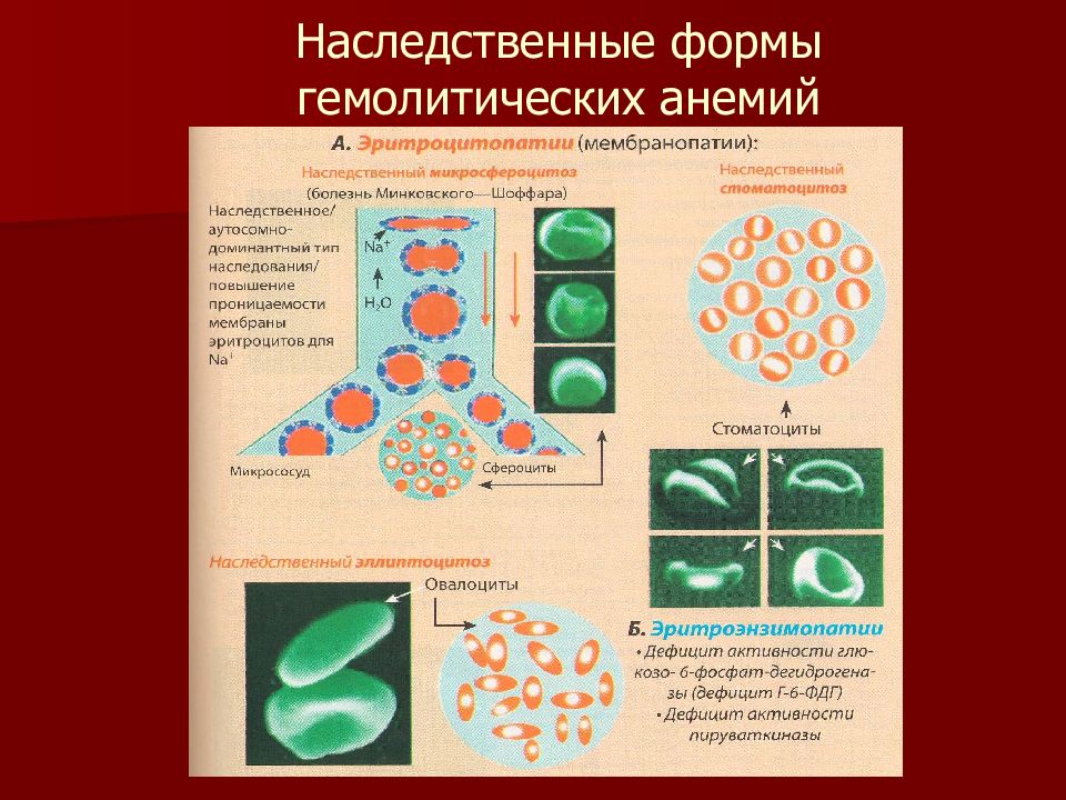 Генетическая форма. Форма эритроцитов при гемолитической анемии. Классификация анемии Минковского Шоффара. Гемолитическая анемия наследственность. Наследственные гемолитич анемии.