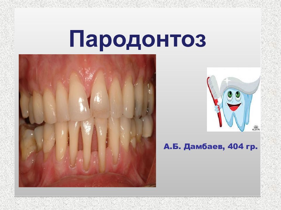 Пародонтоз А.Б. Дамбаев, 404 гр.