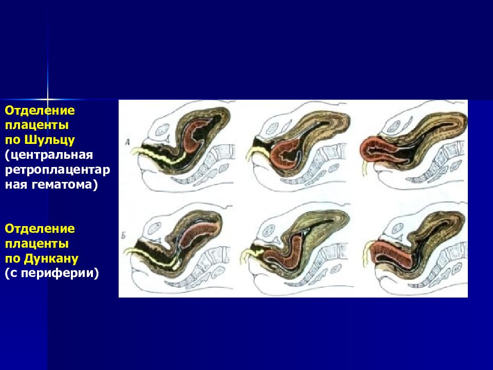Механизм отделения плаценты по Шульце. Отделение последа по Шульцу и Дункану. Отделение плаценты по Дункану. Отделение последа по Дункану.