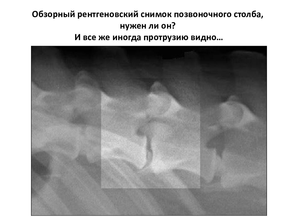 Уровень на рентгене