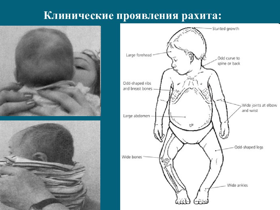 Рахит у детей симптомы. Клинические проявления рахита. Клинические симптомы рахита. Изменения скелета при рахите. Изменение черепа при рахите.