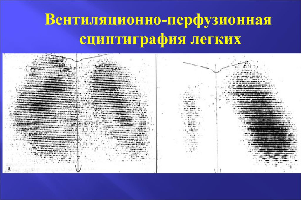 вентиляционная сцинтиграфия легких. сцинтиграфия при легочной гипертензии. перфузионно вентиляционная сцинтиграфия. препараты для сцинтиграфии. вентиляционно-перфузионная сцинтиграфия.