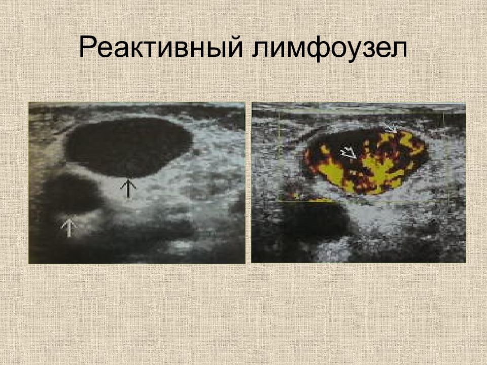 Изменение лимфатического узла. Реактивные изменения лимфоузлов на УЗИ. Реактивные изменения лимфатических узлов. Реактивный лимфоузел УЗИ.