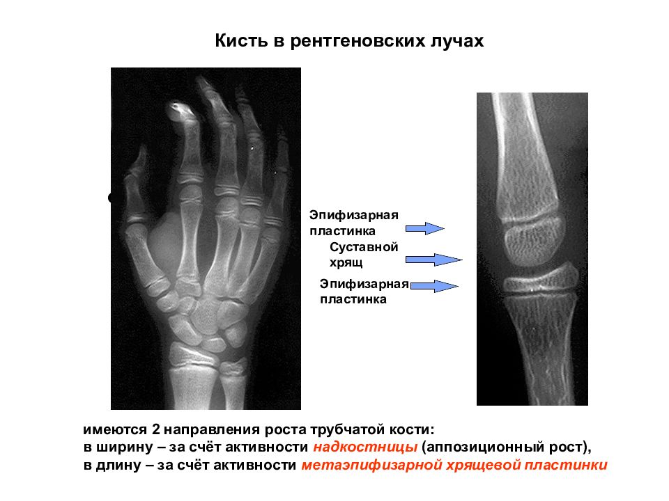 Пластина роста. Эпифизарная пластинка на рентгене. Эпифизарные зоны роста костей. Эпифизарная пластинка роста кости. Эпмфизарная попатинка.
