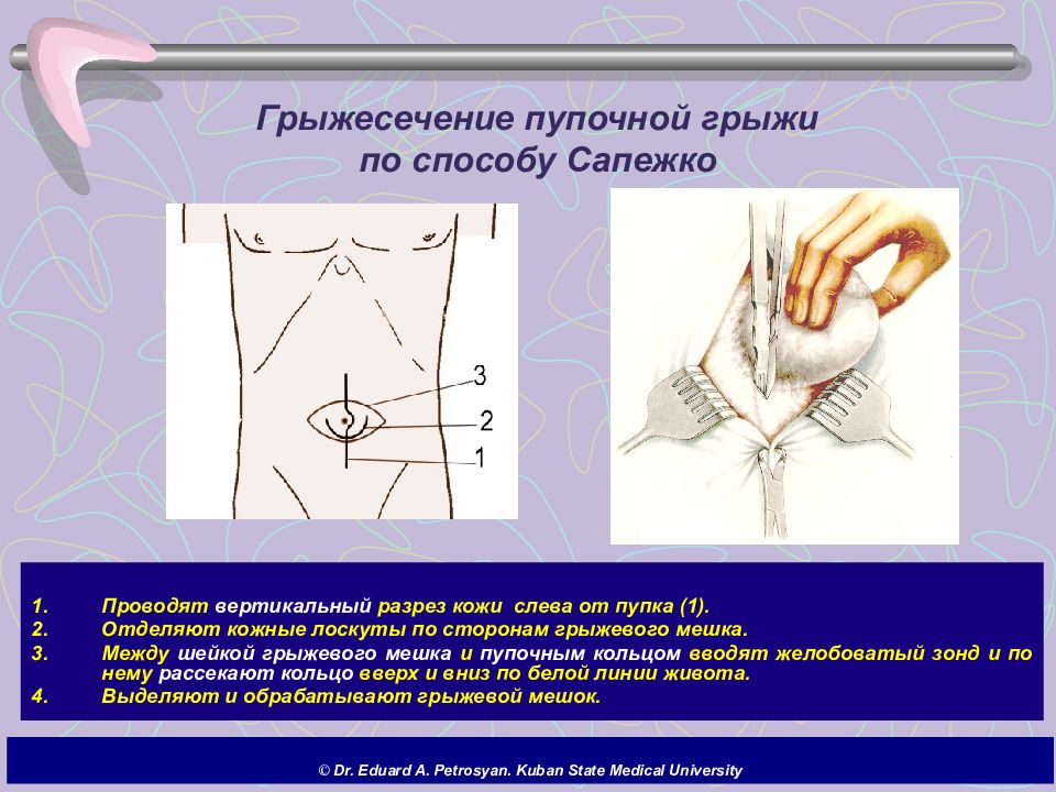 Презентация грыжи живота хирургия