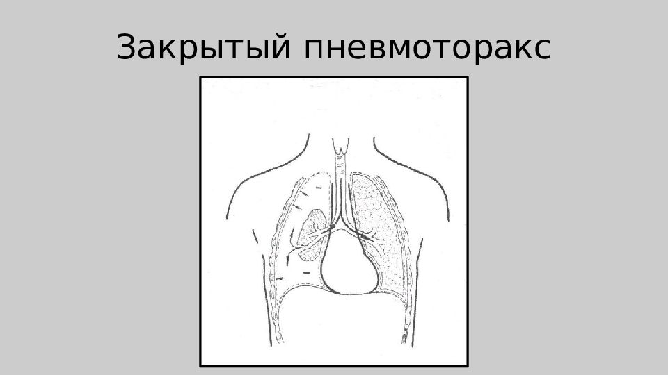 Закрытый пневмоторакс это