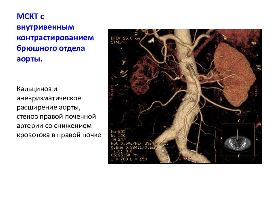 Кальцинаты в стенках аорты