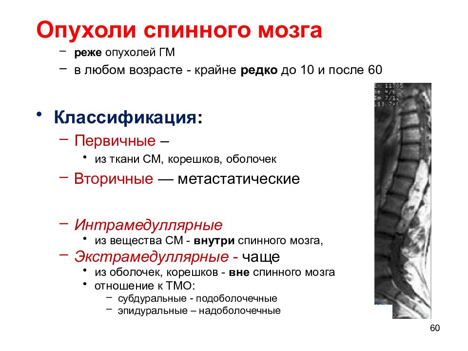 Опухоли головного мозга неврология презентация