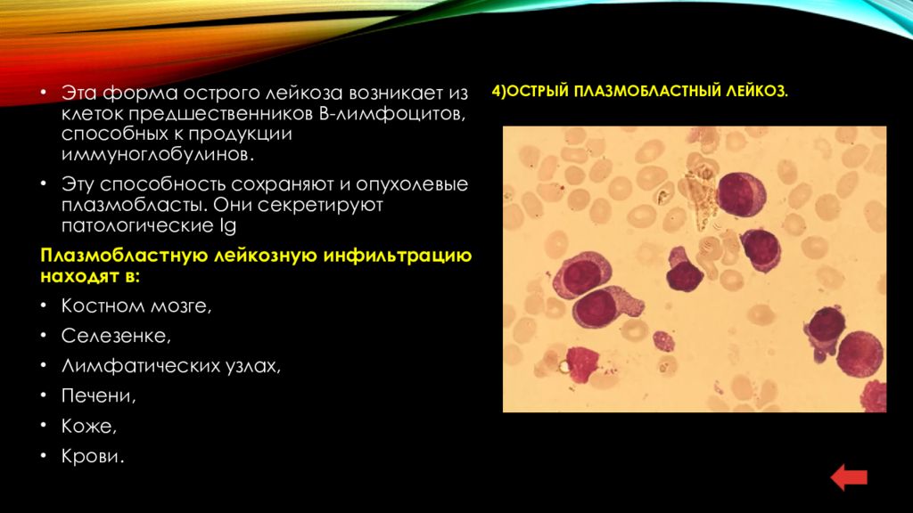 Острый лимфолейкоз презентация