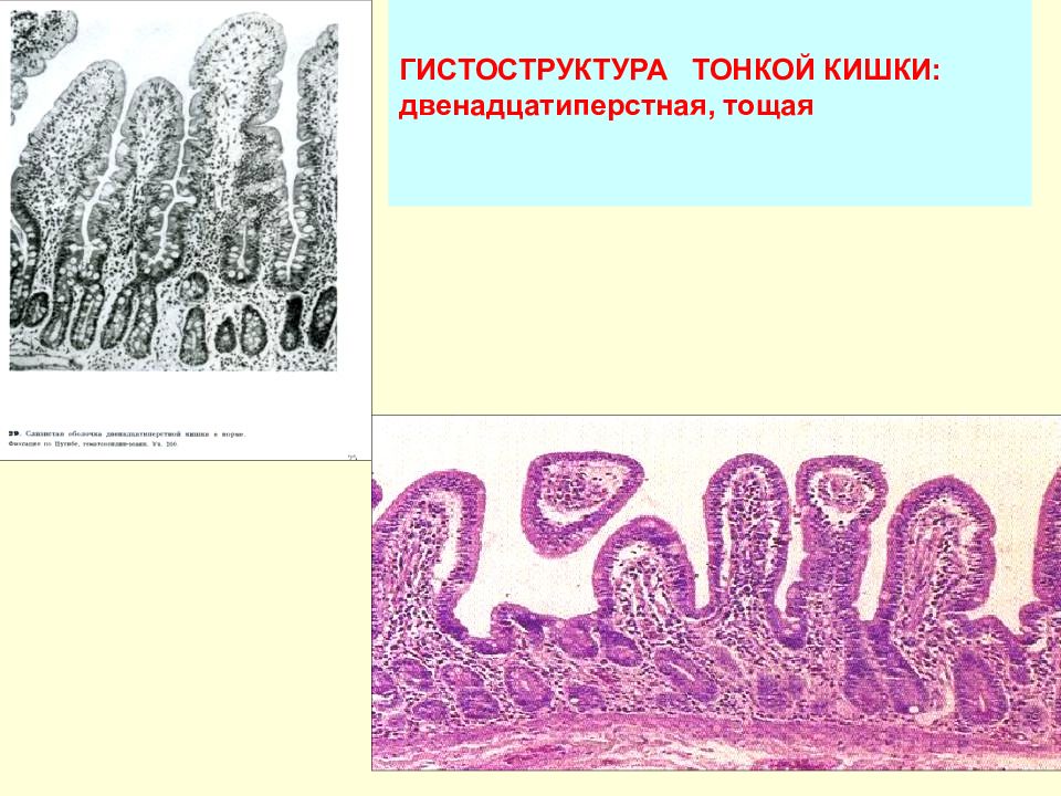 Среда тонкой кишки. Желудочно кишечная форма сибирской язвы.