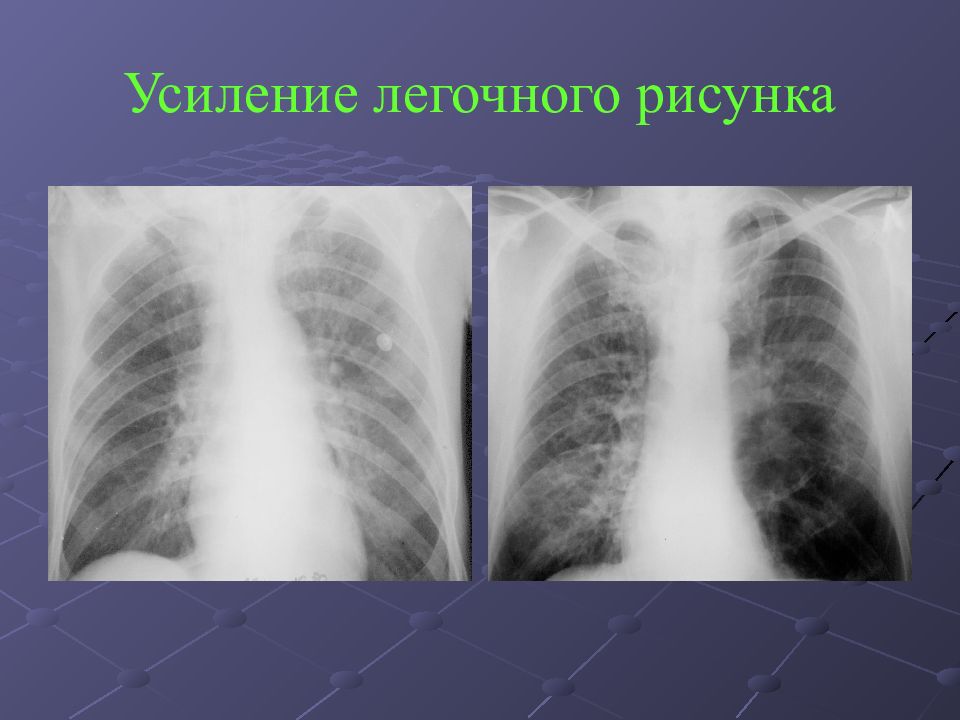 Легочно сосудистый рисунок усилен. Усиление легочного рисунка на рентгене. Рентген легких усиление легочного рисунка. Синдром обогащения легочного рисунка. Усил ение логочного рисунка.