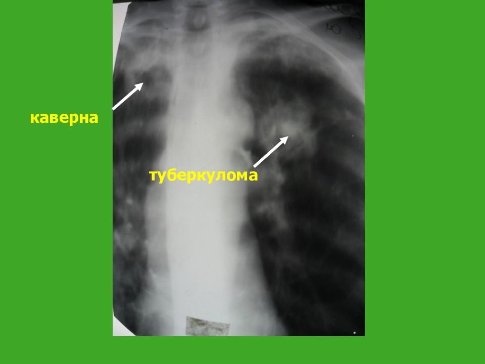 Презентация туберкулема легких