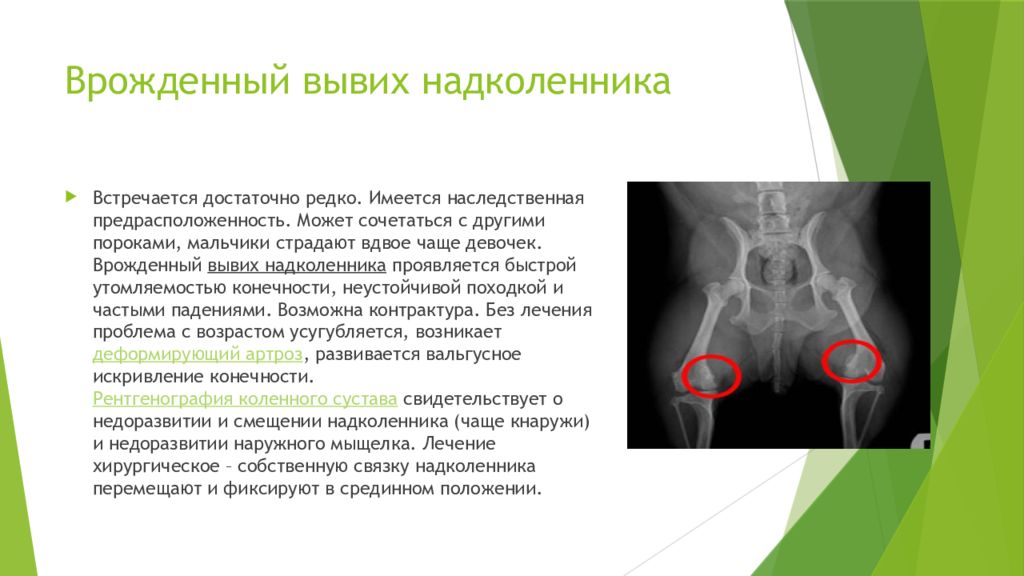 Вывих коленной чашечки. Врожденный вывих надколенника рентген. Врожденный вывих (латеропозиция) надколенника. Врожденный вывих (латеропозиция) надколенника патогенез. Диспластический вывих надколенника.