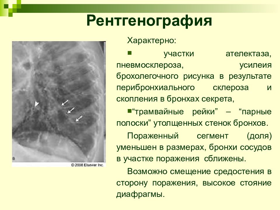 Рентген признаки. Пневмосклероз рентген признаки. Бронхоэктаз рентген признаки. Рентген признаки пневмофиброза. Бронхоэктатической пневмосклероз.