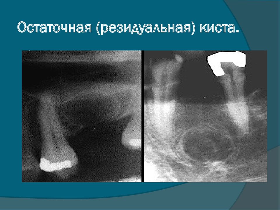 Резидуальная киста. Резидуальная киста рентген. Резидуальная радикулярная киста. Резидуальная киста нижней челюсти кт.