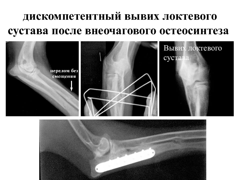 Левый локтевой сустав. Внеочаговый остеосинтез. Подвывих локтевого сустава. Вывих локтевого сустава рентген. Подвывих левого локтевого сустава.