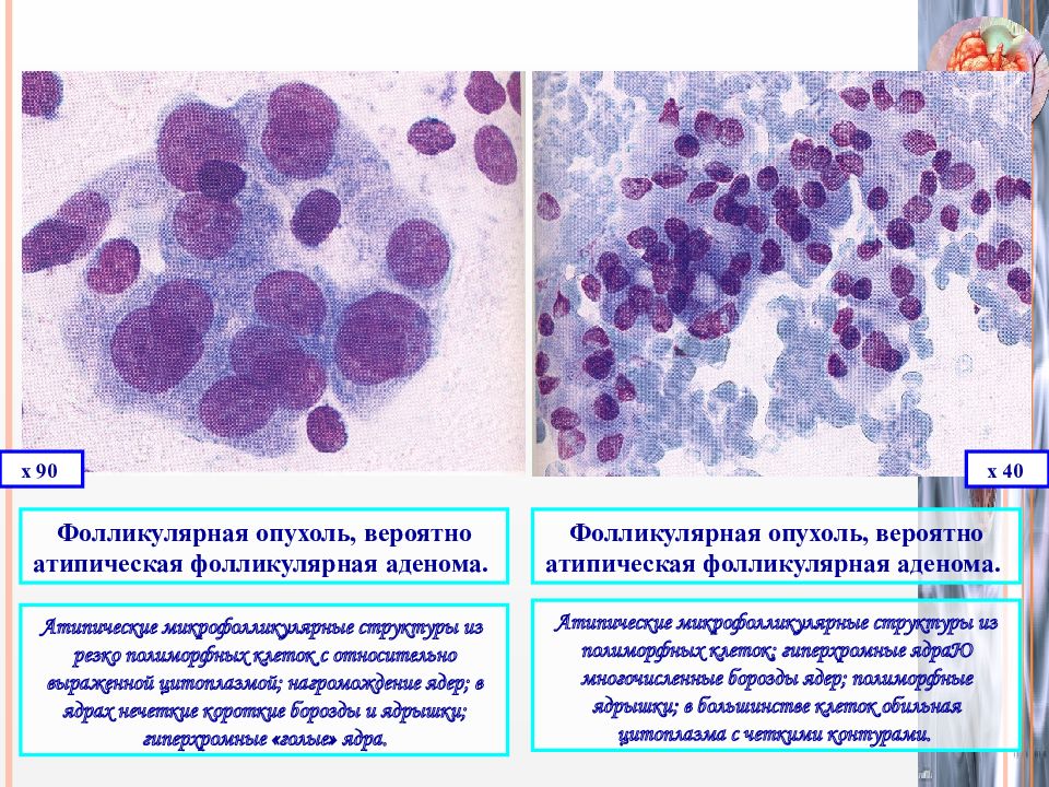 Атипичные клетки в цитологии что это. Фолликулярная кератома гистология. Фолликулярная карцинома щитовидной железы гистология. Атипическая аденома щитовидной железы гистология. Цитологическая картина фолликулярной опухоли.