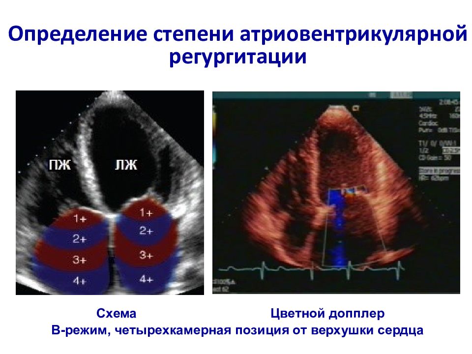 Митральная регургитация 1 2 степени