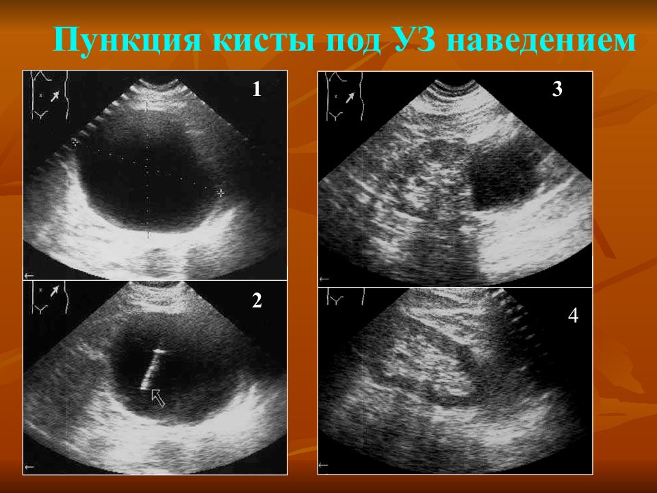 Киста в мм. Пункция кисты поджелудочной железы.