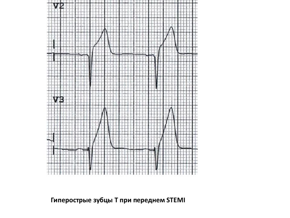 Отрицательный зубец т на экг. Коронарный зубец т на ЭКГ. Высокоамплитудные зубцы т на ЭКГ. Высокий коронарный т на ЭКГ. Отрицательный коронарный зубец т.