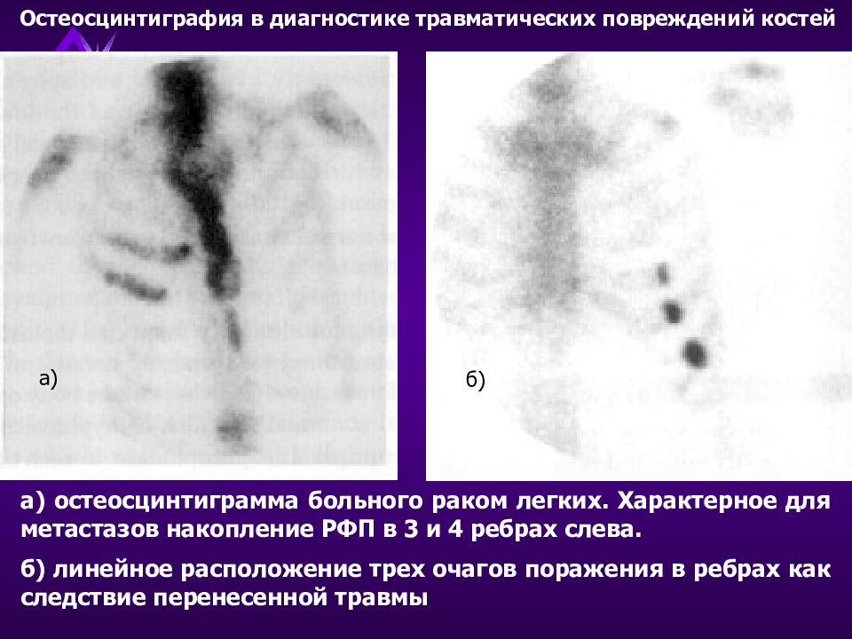 Гиперфиксация рфп что это такое. Накопление РФП В костях что это. Очаг гиперфиксации РФП что это. Накопление РФП В лимфоузлах.