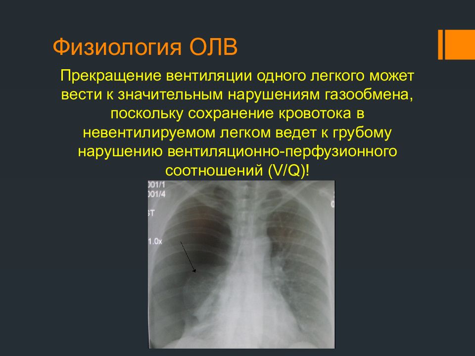 Торакальный это. Торакальная операция на легком что это. Анестезиология в торакальной хирургии. Вентиляционные нарушения на рентгенограмме. Нарушение газообмена в легких симптомы.