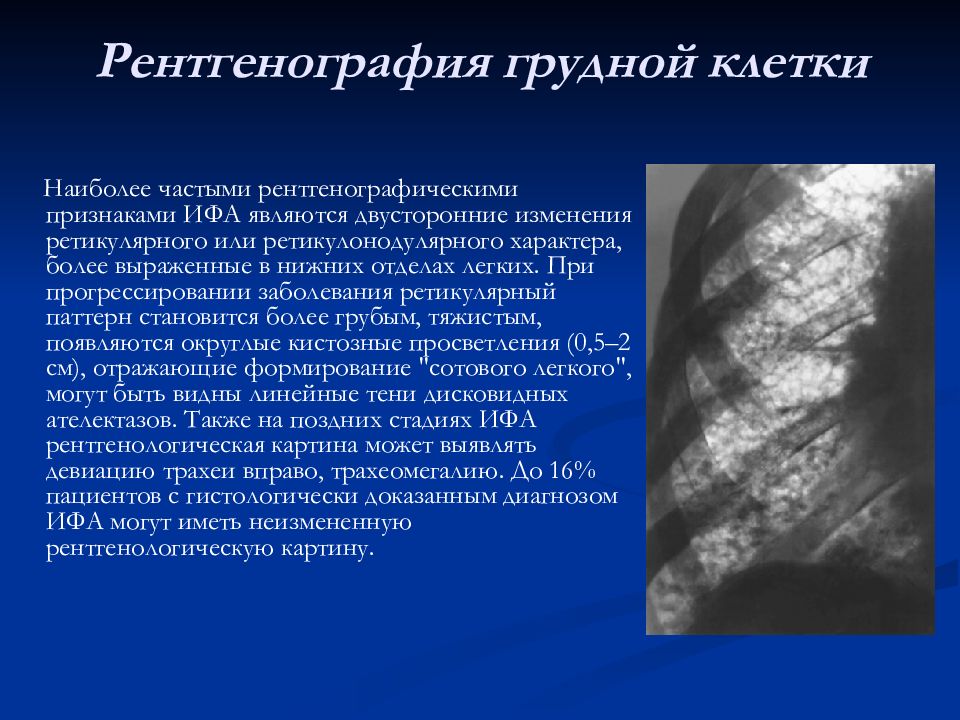 Презентация идиопатический фиброзирующий альвеолит