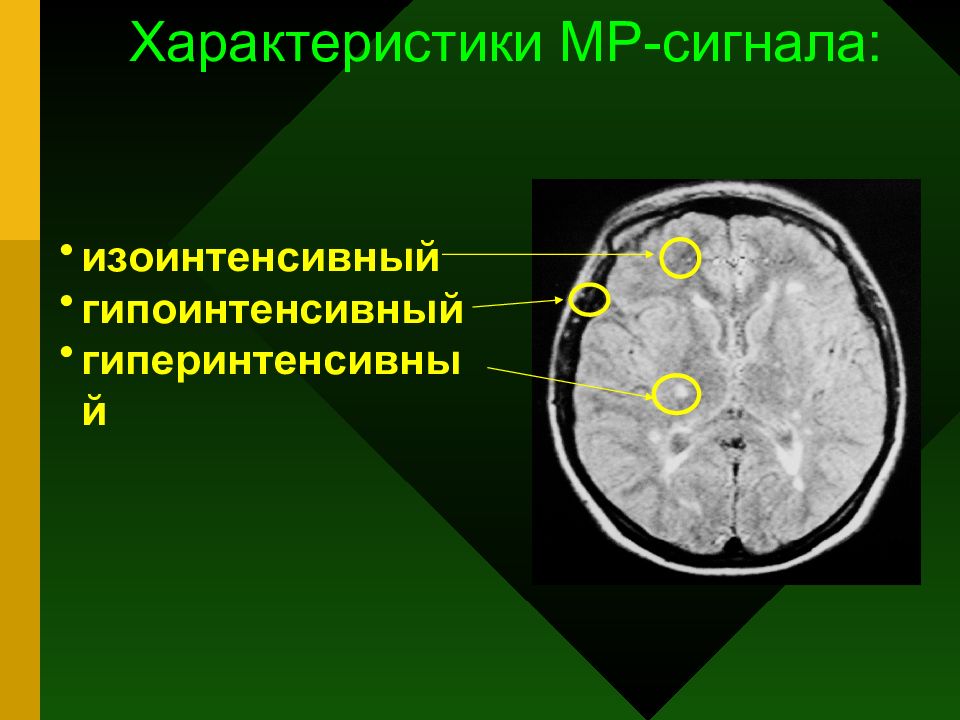 Т1 взвешенное изображение мрт