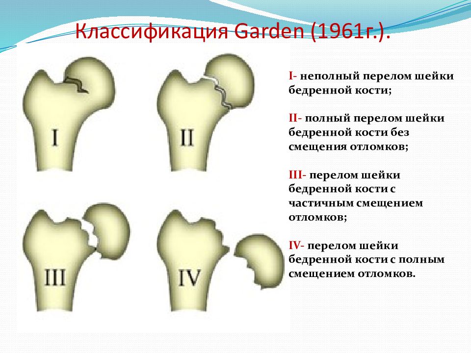 Перелом бедренной кости клинические рекомендации тесты нмо. Классификация Garden переломы шейки бедра. Классификация переломов шейки бедренной кости. Переломы шейки бедра классификация рентген. Классификация Гардена перелом шейки бедра.