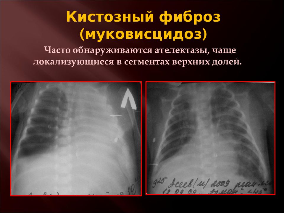 Последствия фиброза. Что такое кистозный фиброз лёгких. Муковисцидоз кистозный фиброз.