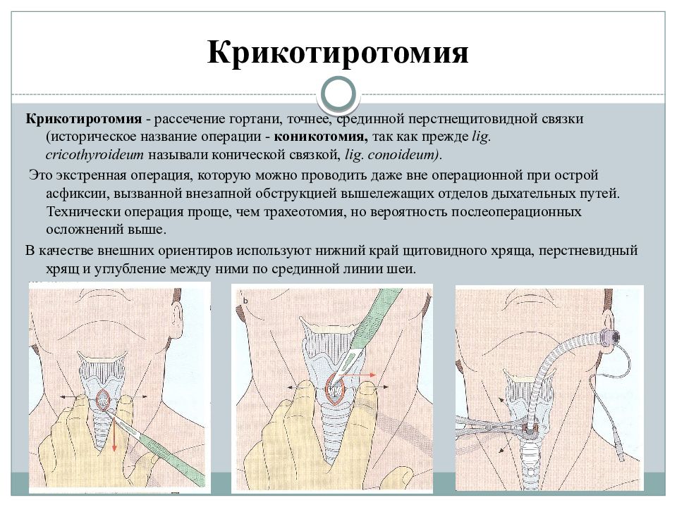 Трахеостомия техника выполнения в картинках для детей