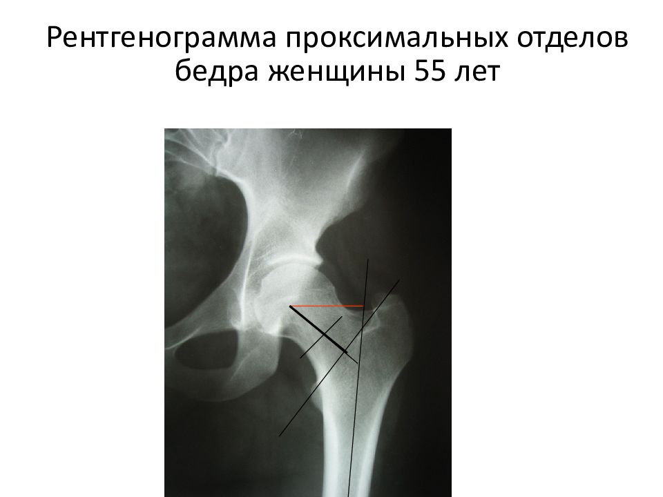 Бедренный отдел. Проксимальный перелом бедренной кости. Проксимальный отдел бедренной кости. Проксимальный перелом бедра. Переломы проксимального отдела бедренной кости.