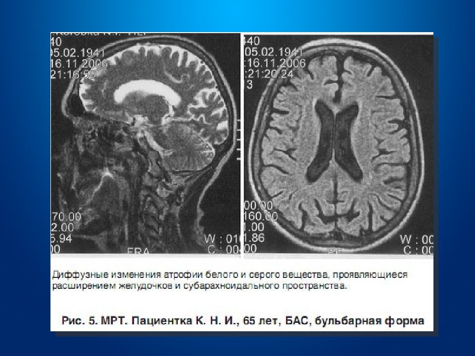 Боковой амиотрофический склероз неврология презентация