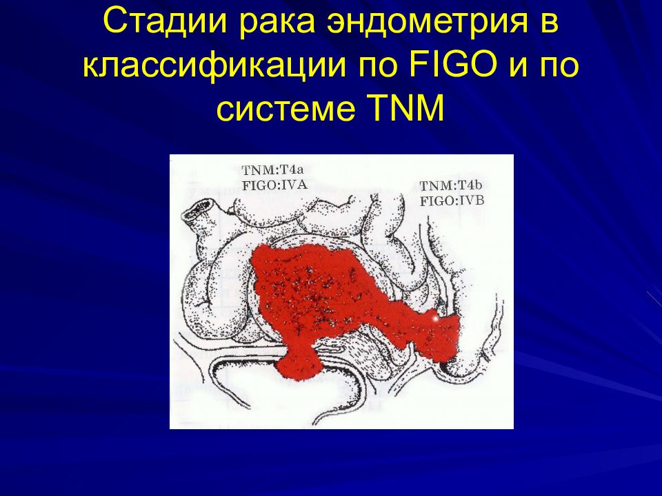 Рак эндометрия картинки