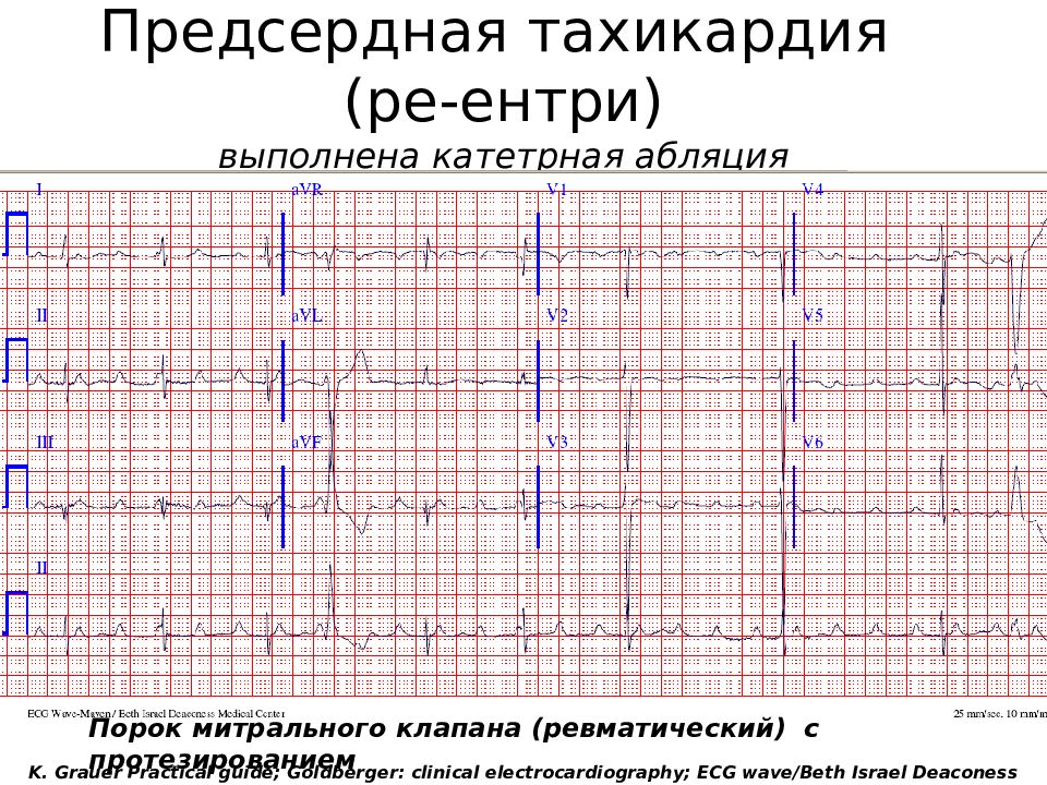 Предсердная тахикардия. Фокусная эктопическая предсердная тахикардия ЭКГ. ЭКГ при многофокусной предсердной тахикардии. Мультифокальная предсердная тахикардия на ЭКГ. Предсердная тахикардия на ЭКГ признаки.