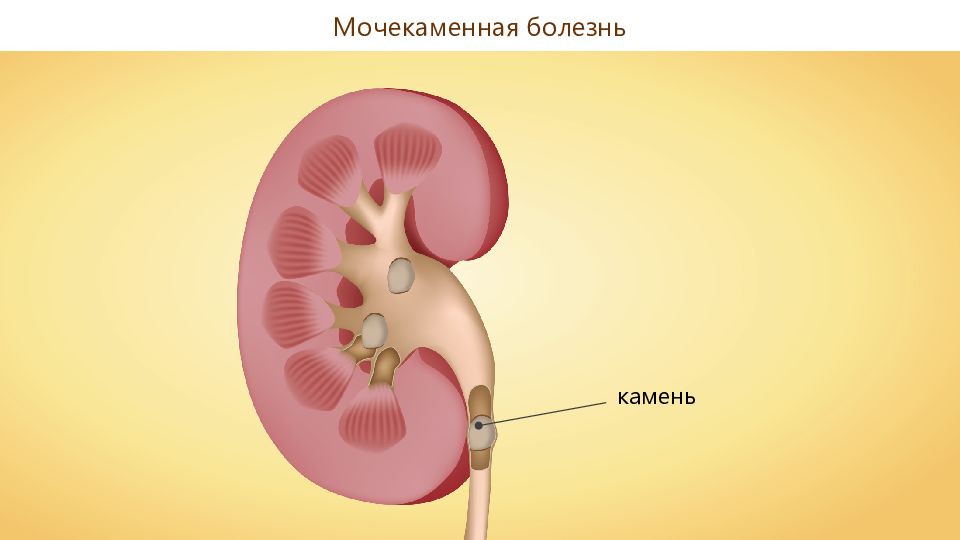 Заболевания органов мочевыделения презентация