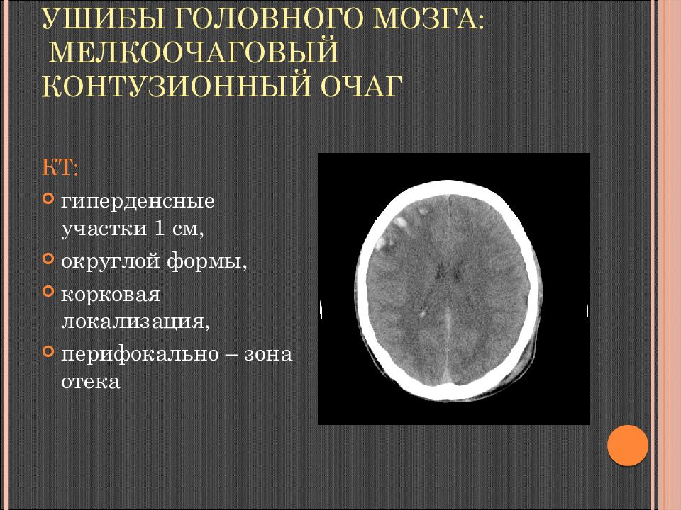 Кт при сотрясении головного мозга