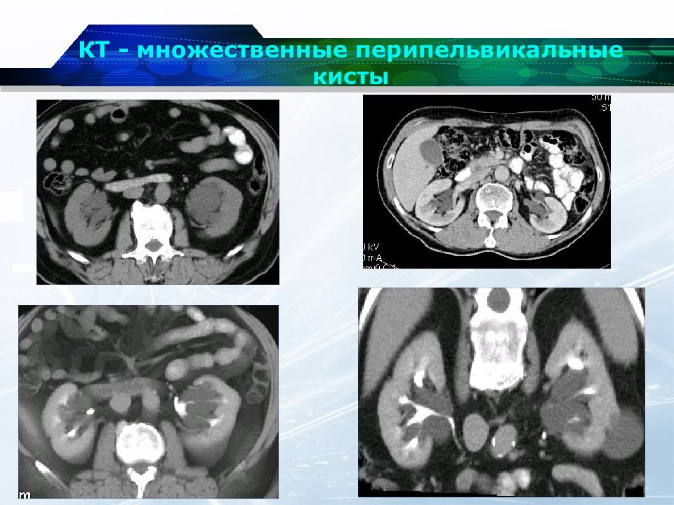 Парапельвикальные кисты почек