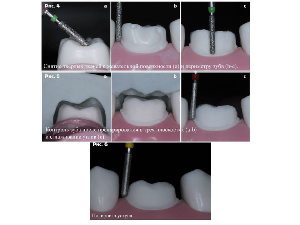 Дефект твердых тканей. Режущий инструмент для препарирования твердых тканей зуба. Препарирование зуба под искусственную коронку. Требования к искусственным коронкам.