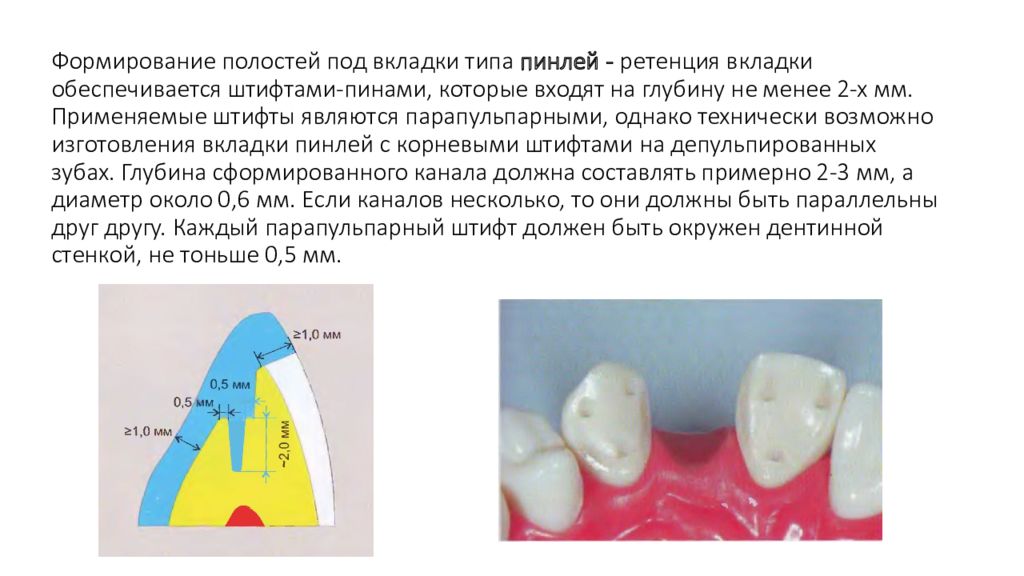 Формирование полости. К основным принципам формирования полостей для вкладок. Формирование полости под вкладку. Формирование полостей под вкладки типа пинлей. Принципы препарирования зубов под вкладки..