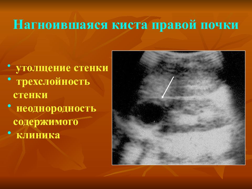 Киста правой почки. Нагноившаяся киста почки на УЗИ. Киста лоханки почки на УЗИ. Кальцинированная киста почки на УЗИ.