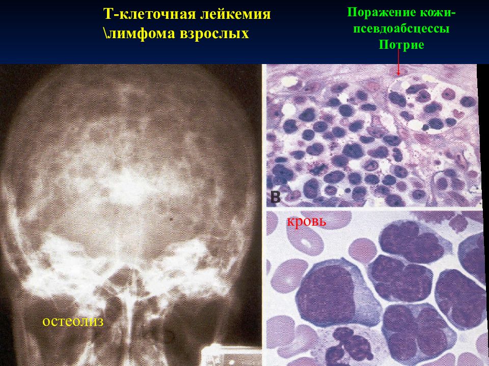 картина крови хронического миелолейкоза